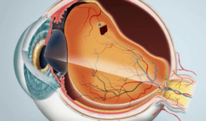 3 tipos de descolamento e Retina e como agem