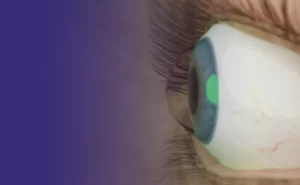 Se você é portador de Ceratocone
