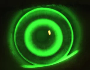 Livre-se dos Óculos e Lentes de Contato Durane o Dia Descubra a Ortoceratologia Livre-se dos Óculos e Lentes de Contato Durane o Dia Descubra a Ortoceratologia_